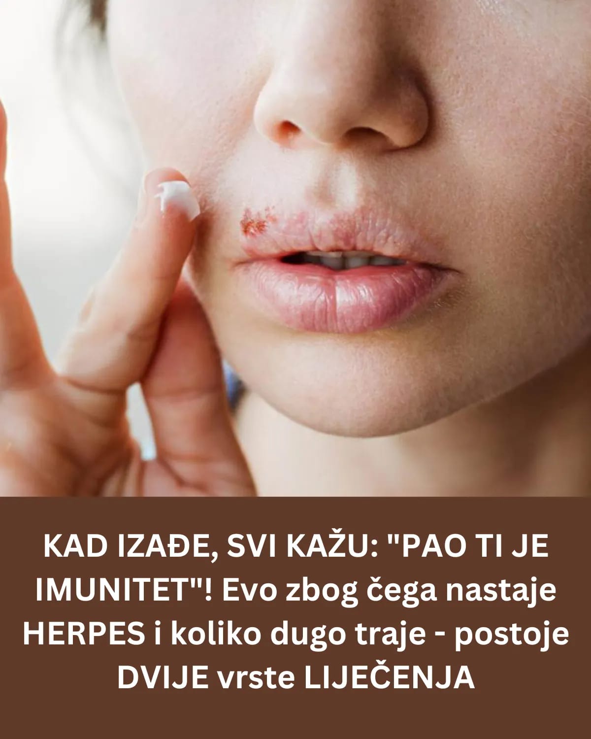 KAD IZAĐE, SVI KAŽU: “PAO TI JE IMUNITET”! Evo zbog čega nastaje HERPES i koliko dugo traje – postoje DVIJE vrste LIJEČENJA