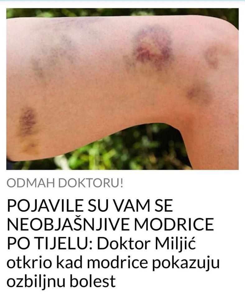 P0JAVILE SU VAM SE NEOBJAŠNJIVE MODRICE PO TIJELU: Doktor Miljić otkrio kad modrice pokazuju ozbiljnu bolest
