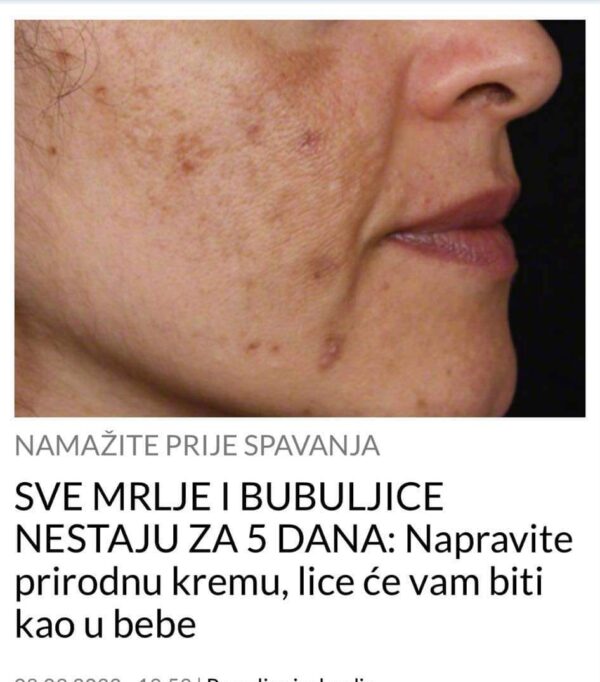 SVE MRLJE I BUBULJICE NESTAJU ZA 5 DANA: Napravite prirodnu kremu, lice će vam biti kao u bebe