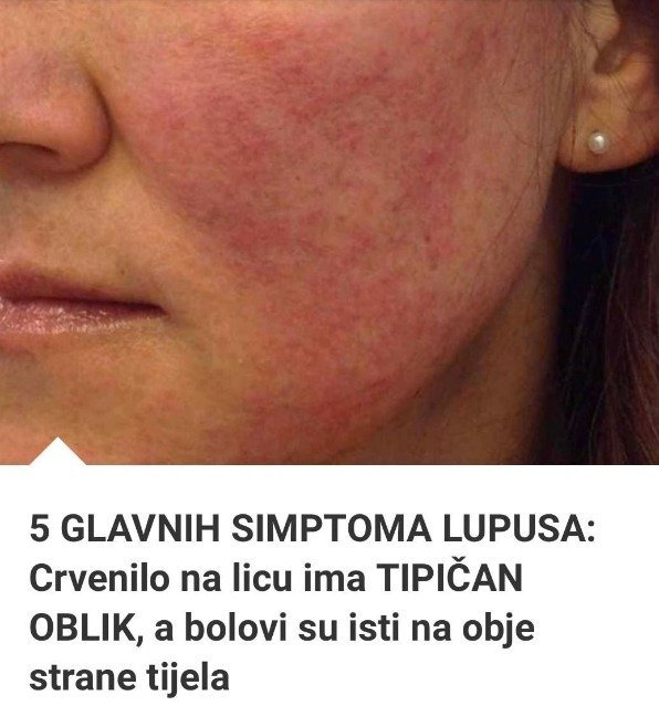5 GLAVNIH SIMPT0MA LUPUSA: Crvenilo na licu ima TIPIČAN 0BLIK, a bolovi su isti na obje strane tijela