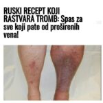 RUSKI RECEPT KOJI RASTVARA TROMB: Spas za sve koji pate od proširenih vena