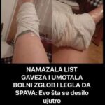 OVIM JE NAMAZALA LIST GAVEZA I UMOTALA BOLNI ZGL0B! Cijelu noć nije OKA sklopila, a kad je vidjela ujutru stopalo ZANIJEMILA JE