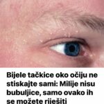 Bijele tačkice oko očiju ne stiskajte sami: Milije nisu bubuljice, samo ovako ih se možete riješiti