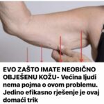 EVO ZAŠTO IMATE NEOBIČNO OBJEŠENU KOŽU- Većina ljudi nema pojma o ovom problemu. Jedino efikasno rješenje je ovaj domaći trik