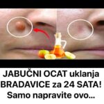 JABUČNI OCAT uklanja BRADAVICE za 24 SATA! Samo napravite ovo…