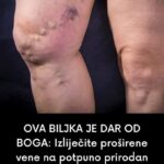 OVA BILJKA JE DAR OD B0GA: Izliječite proširene vene na potpuno prirodan način