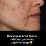 NAJBOLJI DERMATOLOG OTKRIO TAJNU: POMIJEŠAJTE OVA DVA SASTOJKA I TAMNE MRLJE ĆE ZAUVIJEK NESTATI