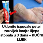 Uklonite ispucale pete i zauvijek imajte lijepa Stopala u 3 dana – KUĆNI LIJEK