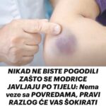 NIKAD NE BISTE POGODILI ZAŠTO SE MODRICE JAVLJAJU PO TIJELU: Nema veze sa POVREDAMA, PRAVI RAZLOG ĆE VAS ŠOKIRATI