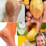 Evo kako da se riješite ispucalih peta preko noći – Sve što vam treba je običan krompir!