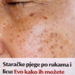 Staračke pjege po rukama i licu: Evo kako ih možete prirodno ukloniti